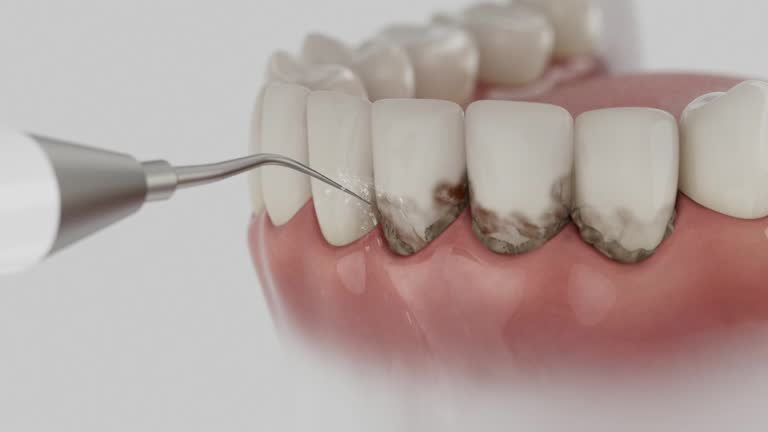 Reliable Wisdom Tooth Removal contractor in Grand County County, CO by Dentist Open Now